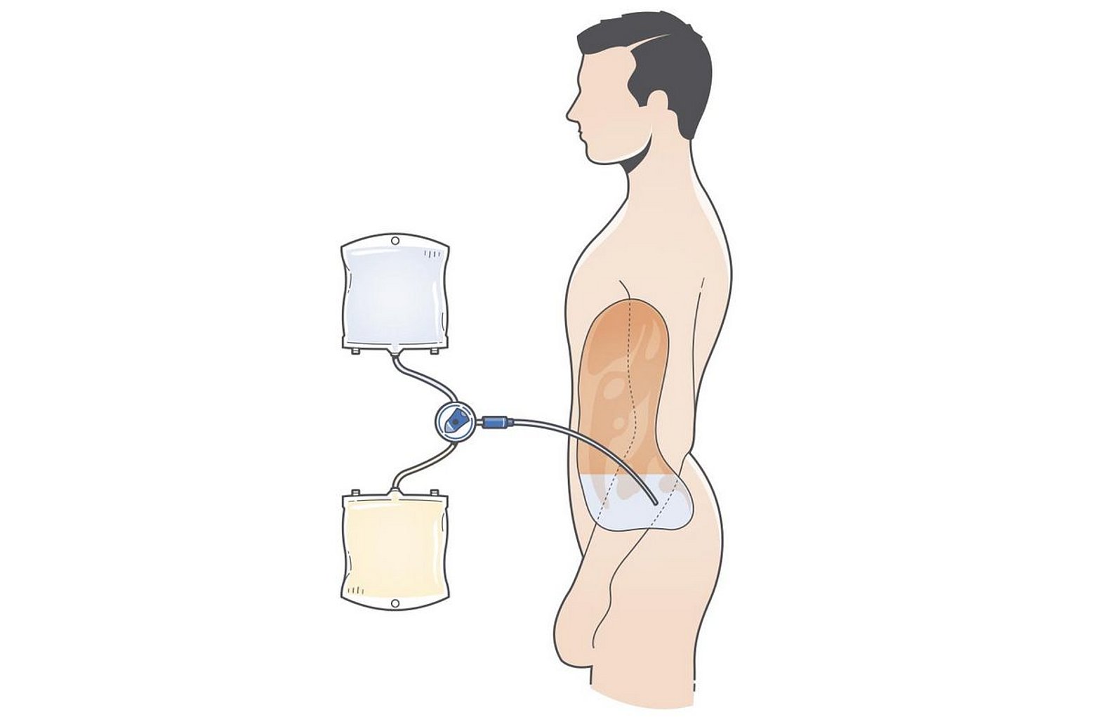 Ilustrace peritoneální dialýzy