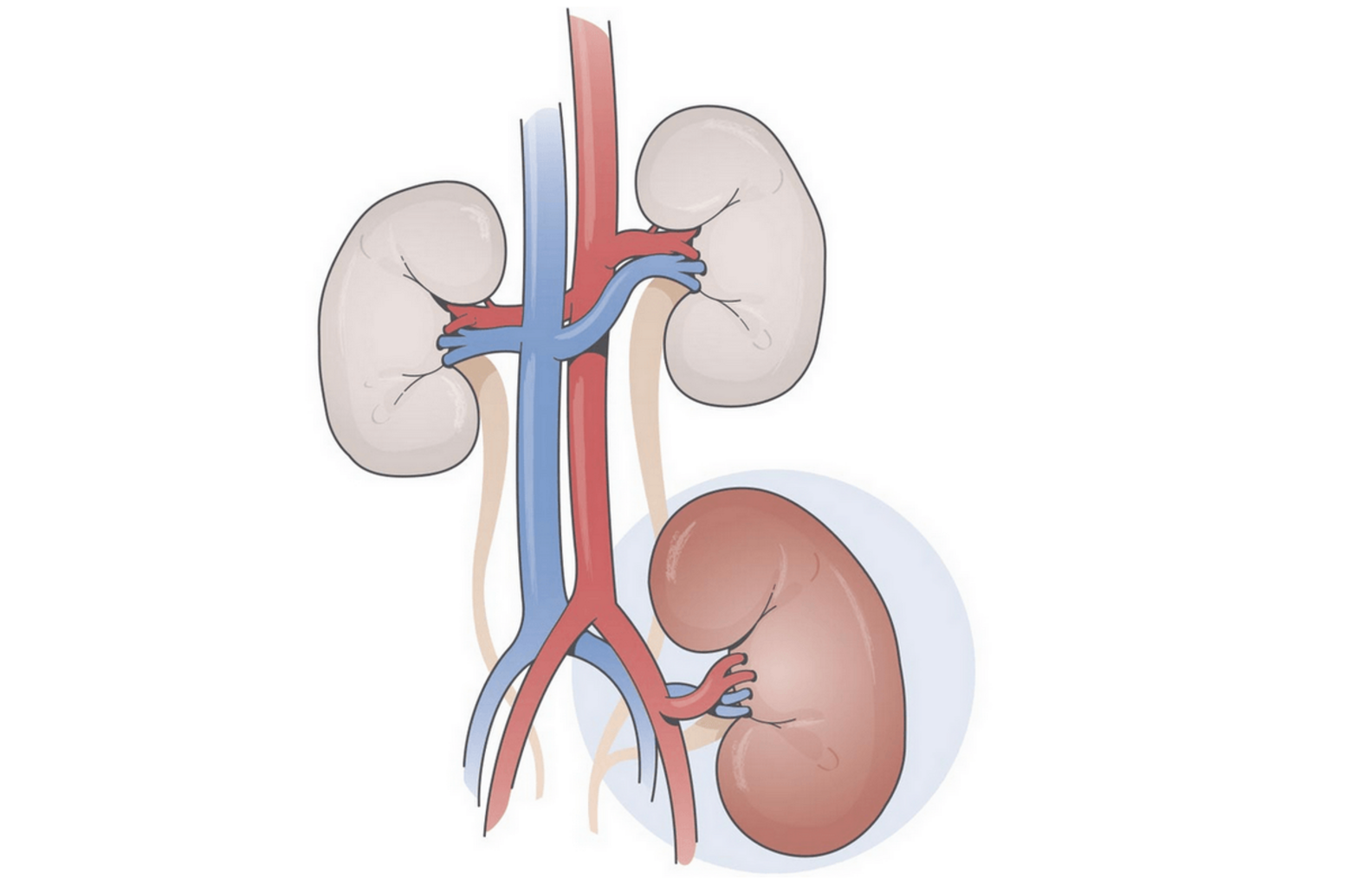 Ilustrace transplantované ledviny