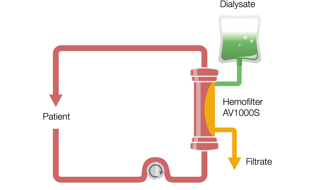 Kontinuální venovenózní hemodialýza (CVVHD)